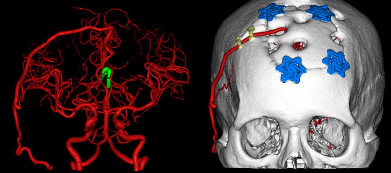 難治性動脈瘤に対するバイパス術後の3次元CTA画像