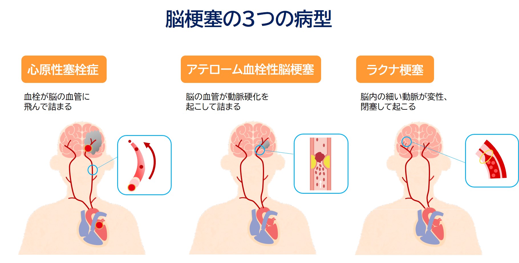 脳梗塞の3つの病型