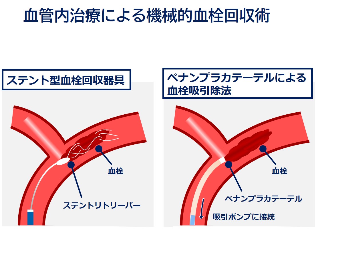 血栓内治療による機械的血栓回収術