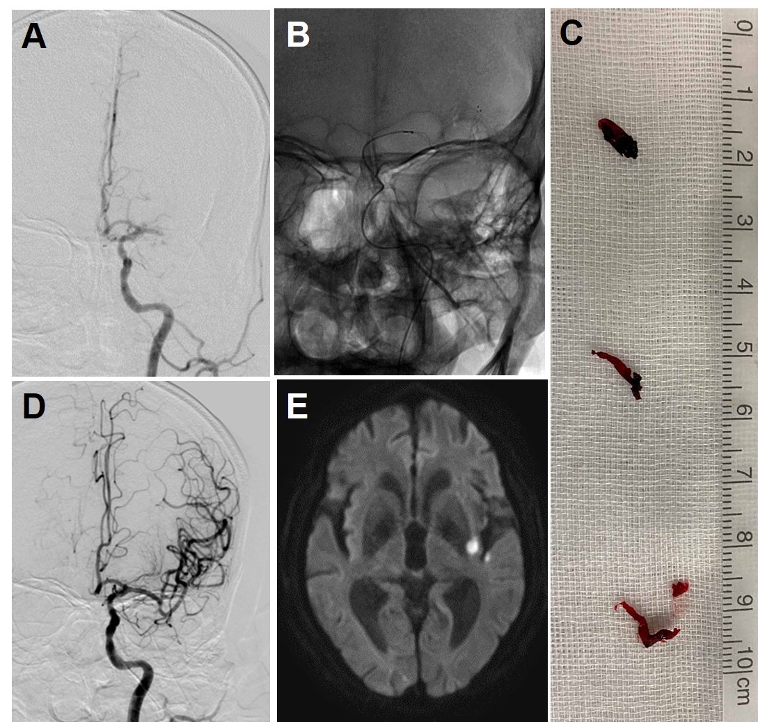 脳梗塞に対する血栓回収術の症例画像