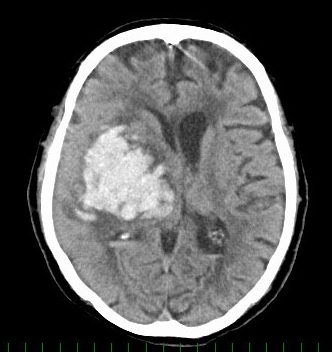 脳出血に対する開頭血腫除去術の症例画像（術前）