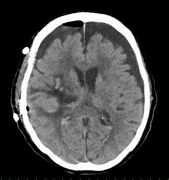 脳出血に対する開頭血腫除去術の症例画像（術後）