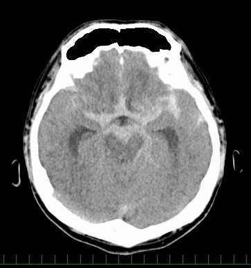 くも膜下出血直後のCT画像