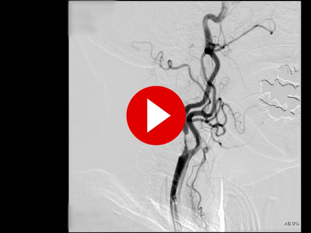 アテローム血栓性脳梗塞に対するCAS（血管内治療）動画サムネイル