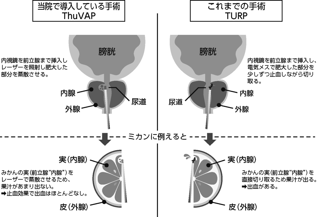 ツリウムレーザー前立腺蒸散術の解説イラスト