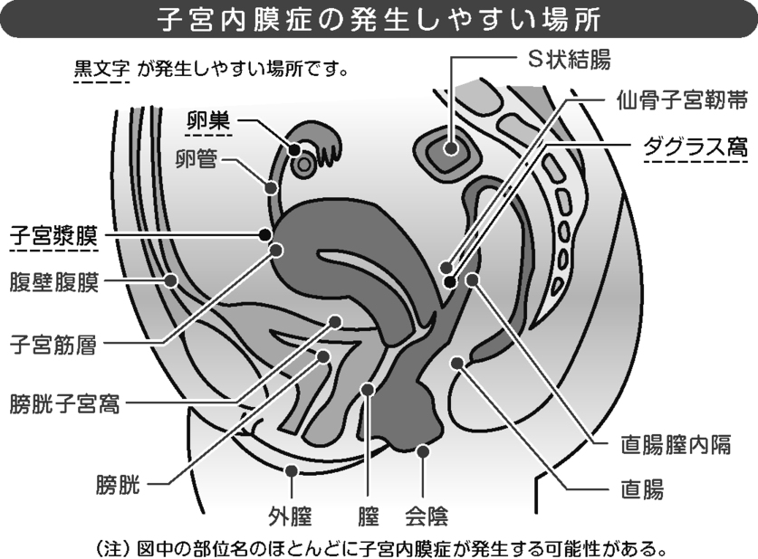 子宮内膜症の発生しやすい場所