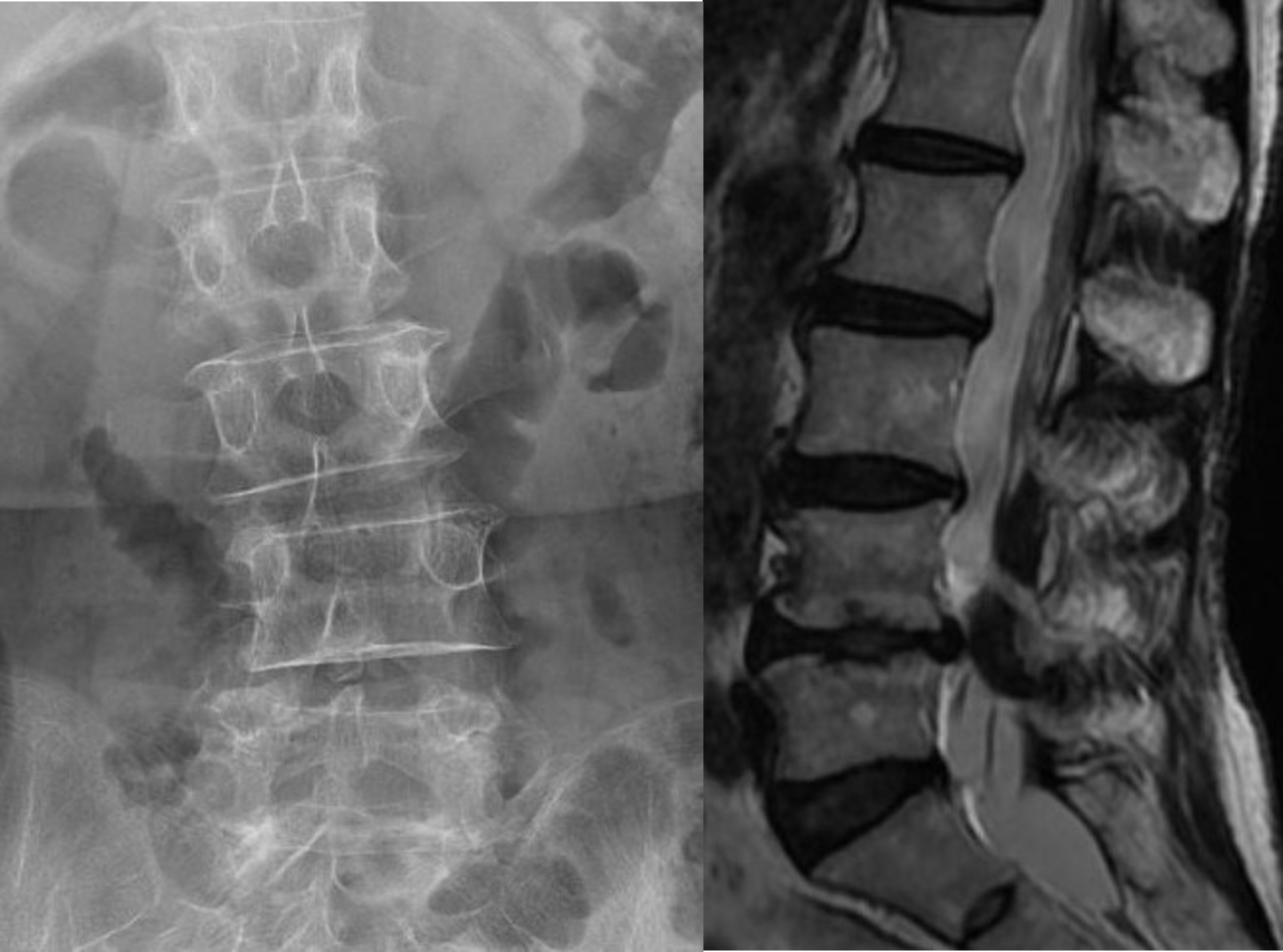 側方すべりを伴った腰部脊柱管狭窄症例