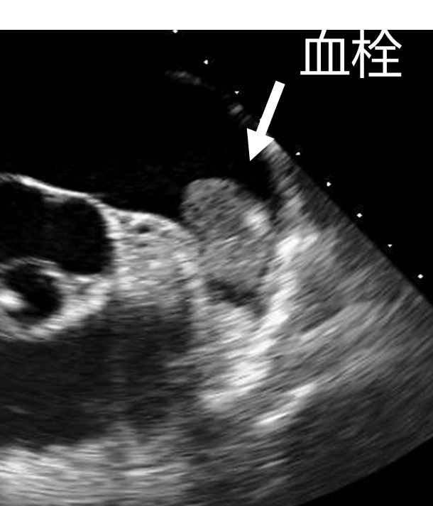 図１　心臓の超音波検査画像　左心耳に血栓が確認できる
