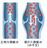 静脈内の血液の逆流