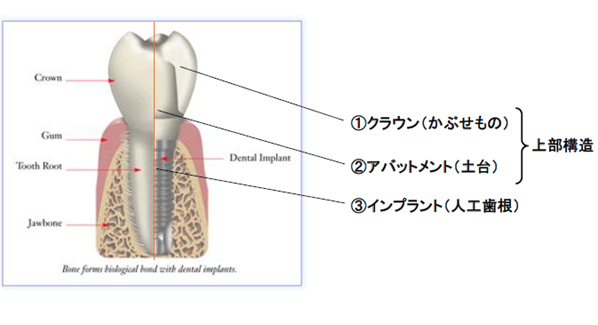 インプラント構造