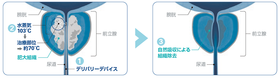 経尿道的前立腺水蒸気治療(WAVE)